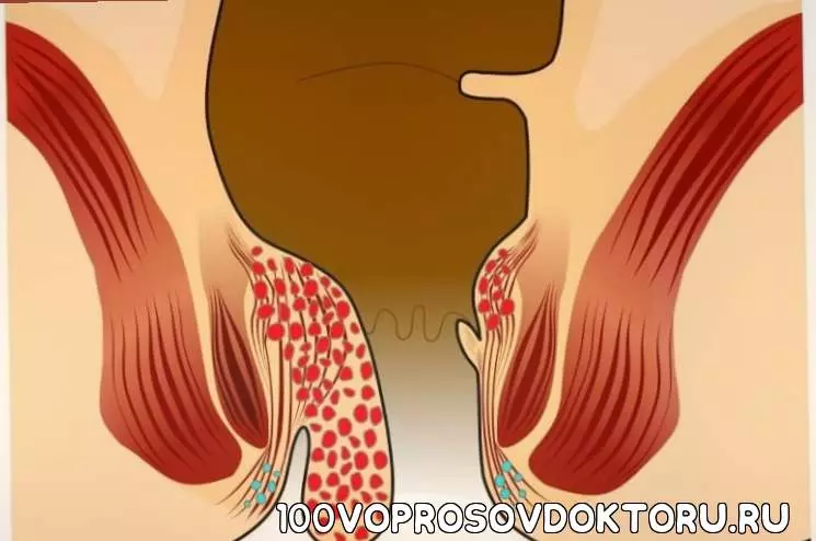 Как выглядит геморрой? 2 вида геморроя, 4 стадии, лечение, фото